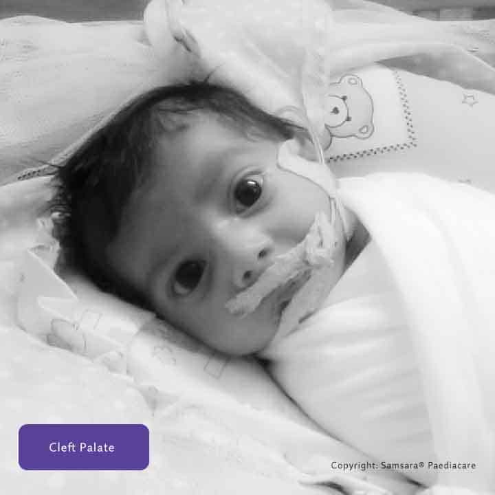 about page what is cleft samsarapaediacare 03